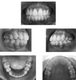 Gambar 5. Fotografi intra oral pasien setelah perawatan                                             Majalah Ortodontik Desember 2014, Edisi kedua 9-11