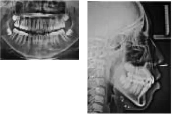 Gambar 6. Radiografi panoramik dan sefalometri setelah perawatan