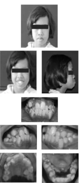 Gambar 1. Ekstra oral dan intra oral sebelum perawatan