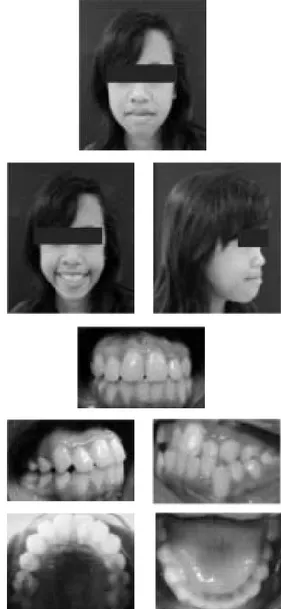 Gambar 4. ekstraoral dan intra oral setelah perawatan