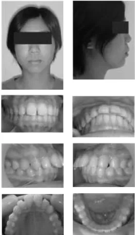 Gambar 1. Foto profil dan intraoral sebelum perawatan, terlihat jarak gigit yang besar disertai spacing.