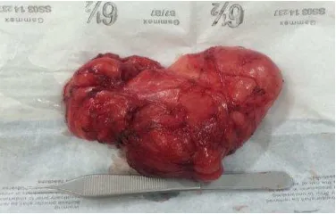 Figure 3b. The tumor was excised in toto.   