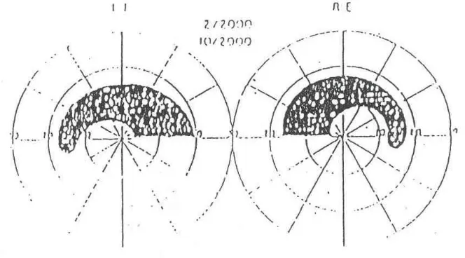 Gambar 3. Baring of  blind spot merupakan tanda awal defek lapang pandandan pada glaucoma.13   