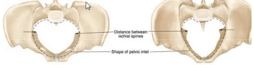 Gambar di atas menunjukkan perbedaan panggul atau pelvis 