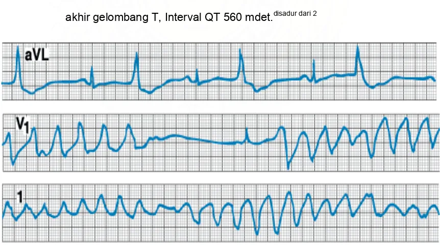 Gambar 2.5.  Gambaran EKG seorang pasien dengan Interval QT memanjang 