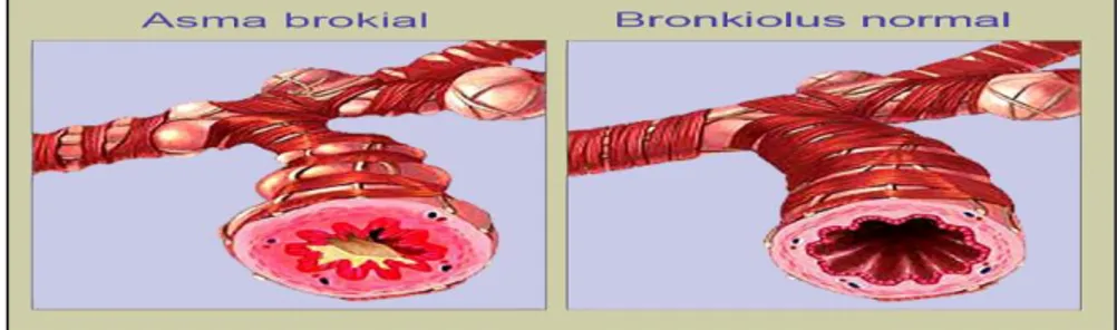 Gambar 1. Perbandingan brokial penderita asma dan brokial normal 4 