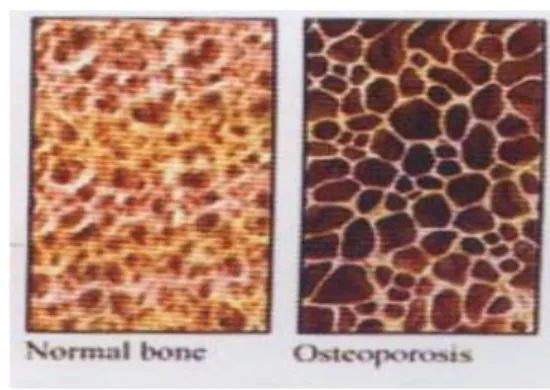 Gambar 1. Gambaran tulang pada orang normal dan osteoporosis  (5)