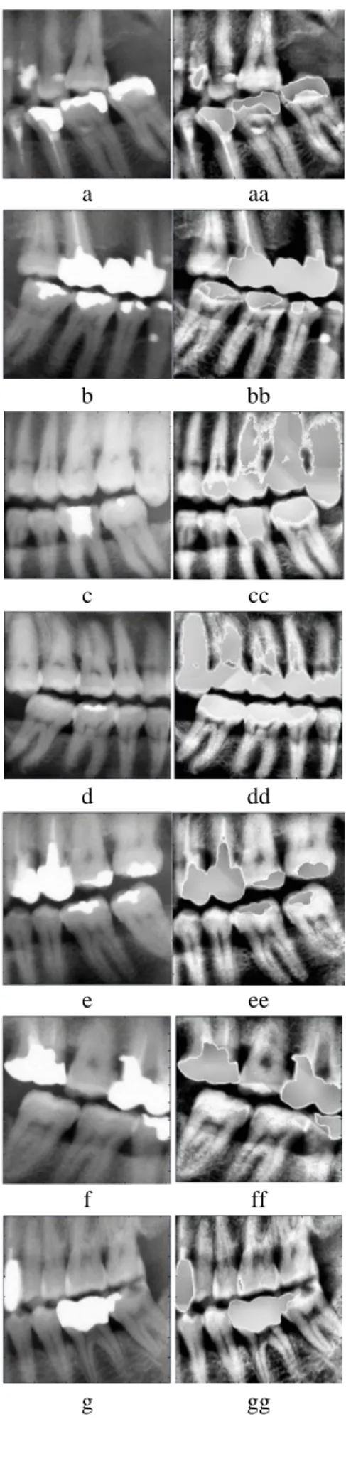Gambar  3  adalah  contoh  hasil  pemisahan  gigi  dengan menggunakan Integral Projection biasa  dan  dengan  menggunakan  Integral  Projection  yang dimodifikasi