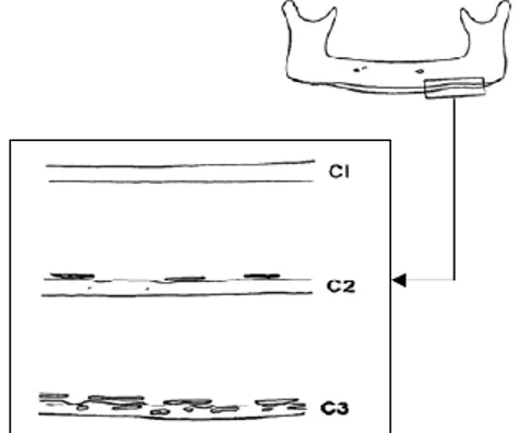 Gambar 2 Gambar ilustrasi klasifikasi endosteal inferior  korteks pada radiografi panoramik