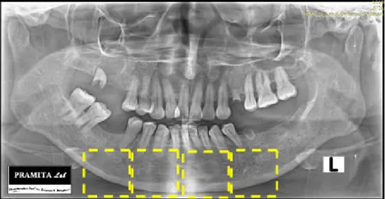 Gambar 2. Citra panorama gigi.  Bagian yang berbentuk persegi merupakan Region Of Interest (ROI)  