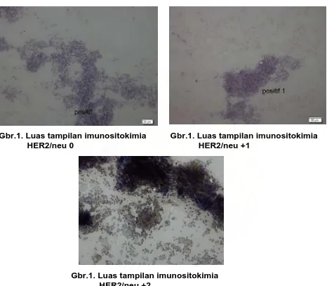 Gambar:  Luas tampilan imunositokimia HER2/neu pada sediaan metastasis                  Karsinoma nasofaring ke KGB leher, tipe quamous cell carcinoma dan                    undifferentiated carcinoma 