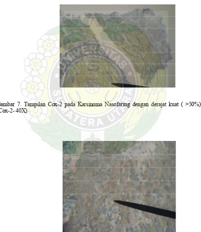 Gambar 6. Tampilan Cox-2 pada Karsinoma Nasofaring dengan derajat sedang (10- 49%) (Cox-2- 400X)  