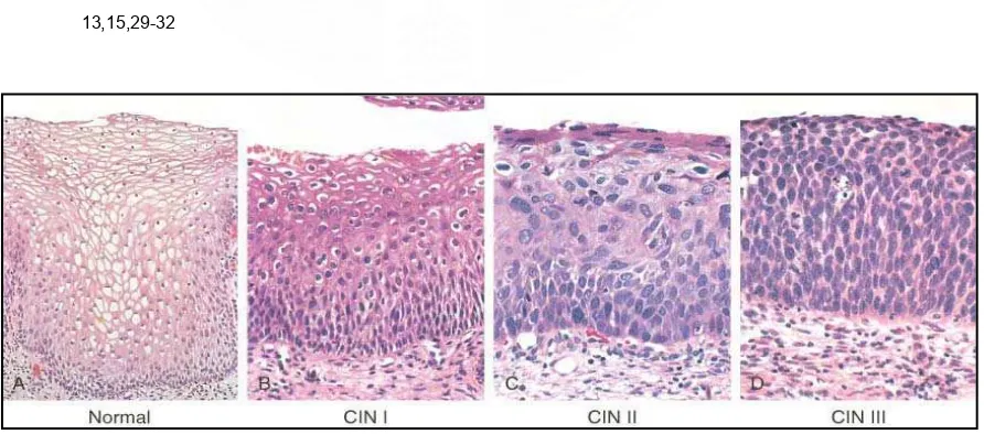 Gambar 2.1. Histopatologi jaringan serviks normal, CIN I, CIN II dan CIN III (Diambil dari kepustakaan no.8) 