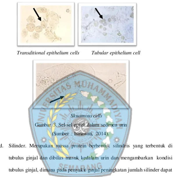Gambar  3. Sel-sel  epitel  dalam  sedimen  urin                (Sumber  :  Ismawati,  2014)