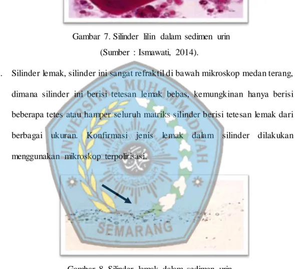 Gambar  8. Silinder  lemak  dalam  sedimen  urin  (Sumber  :  Ismawati,  2014). 