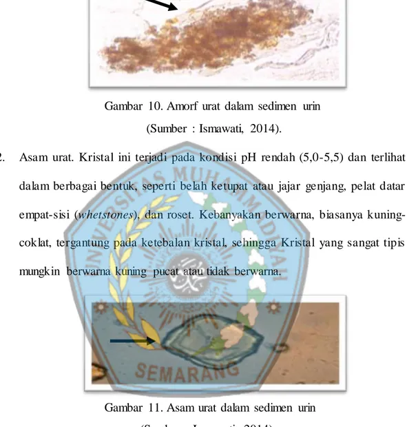 Gambar  11. Asam  urat  dalam  sedimen  urin      (Sumber  :  Ismawati,  2014). 