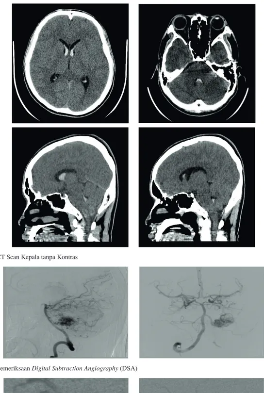 Gambar 1.  CT Scan Kepala tanpa Kontras