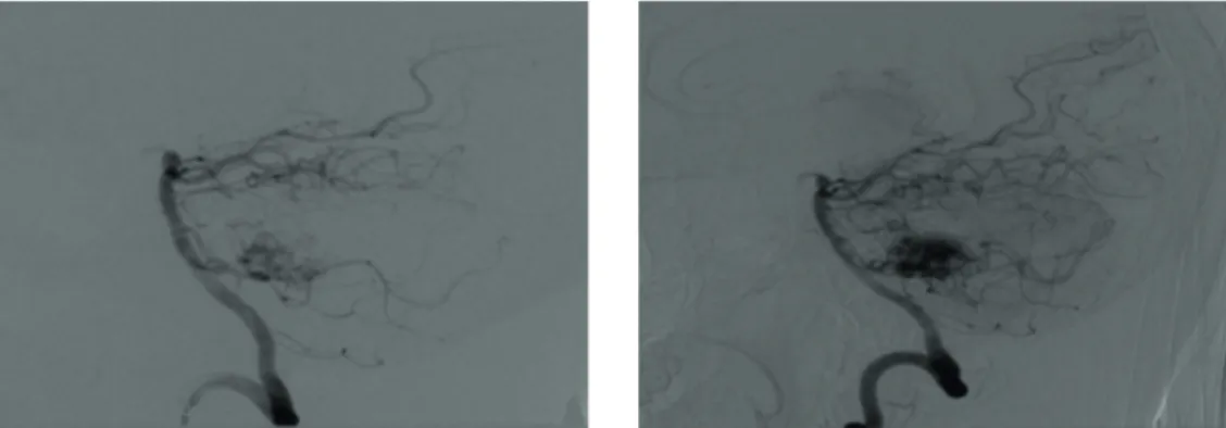 Gambar 4. Pemeriksaan  Digital Subtraction Angiography (DSA) sebelum dan sesudah embolisasi