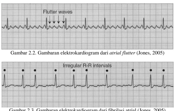 Gambar 2.3. Gambaran elektrokardiogram dari fibrilasi atrial (Jones, 2005) 