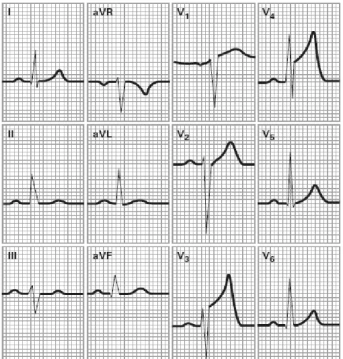 Gambar 2.4. Gambaran elektrokardiogram dari infark miokardium anterior (Jones,  2005) 