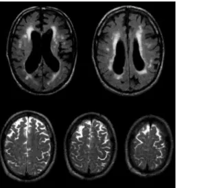 Gambar 2: Gambaran CT-scan pada penderita hidrosefalus  6 