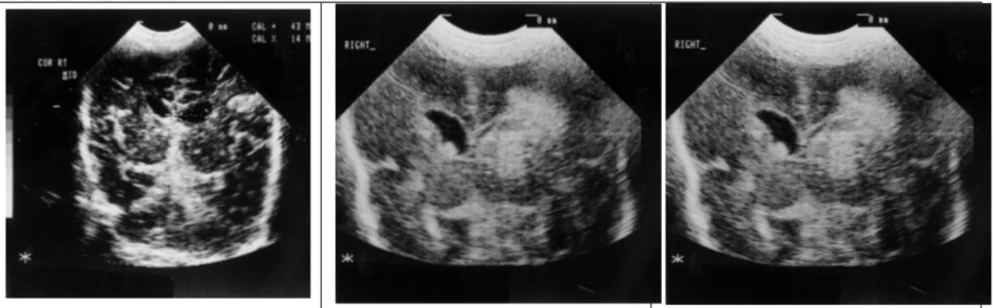 Gambar 2. Dari kiri ke kanan: Coronal ultrasound scan demonstrating an intermediate grade 1/ grade 2, grade 3, and  grade 4  intraventricular  hemorrhage  (IVH)