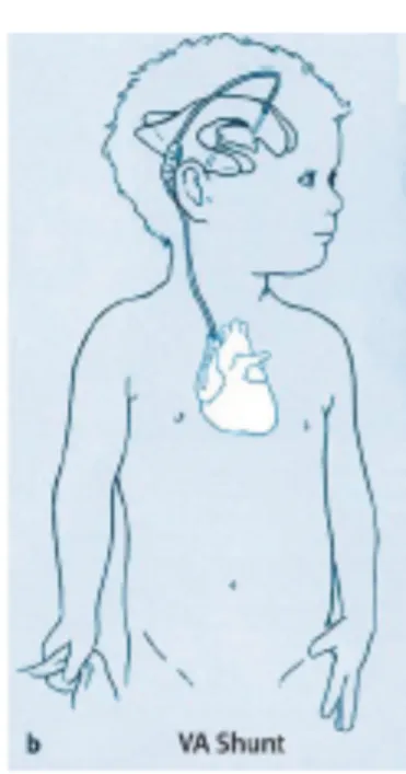 Gambar 2.6 Pemasangan ventriculoarterial shunt. (Dikutip dari : Cathy C. Cartwright and  Donna C