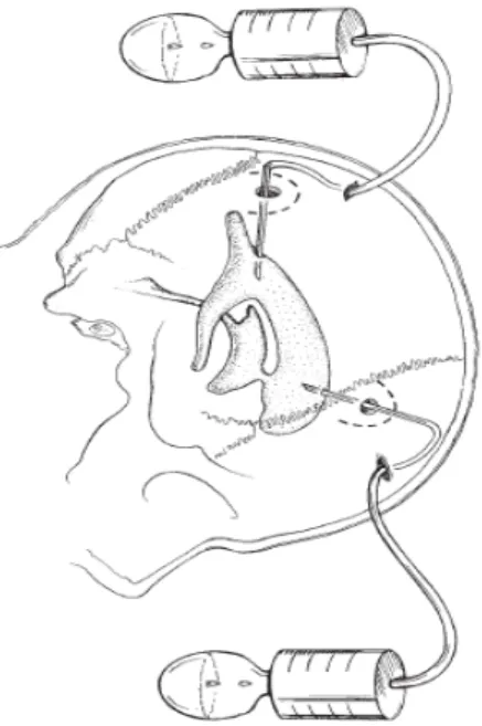 Gambar 2.7 Pemasangan EVD dari bagian posterior dan frontal. (Dikutip dari: 