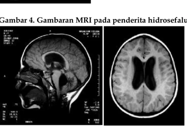 Gambar 3. Gambaran CT-scan pada penderita hidrosefalus 