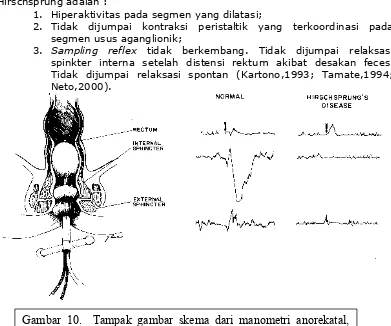 Gambar 10.  Tampak gambar skema dari manometri anorekatal,yang memakai balon berisi udara sebagai transducernya