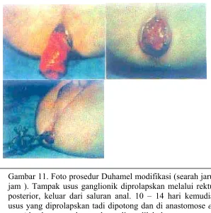 Gambar 11. Foto prosedur Duhamel modifikasi (searah jarumjam ). Tampak usus ganglionik diprolapskan melalui rektumposterior, keluar dari saluran anal