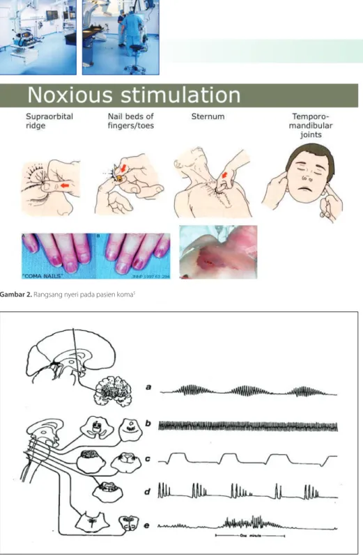 Gambar 3. Pola pernapasan abnormal: A. Pernapasan Cheyne-Stokes; B. Central hyperventilation; C dan D