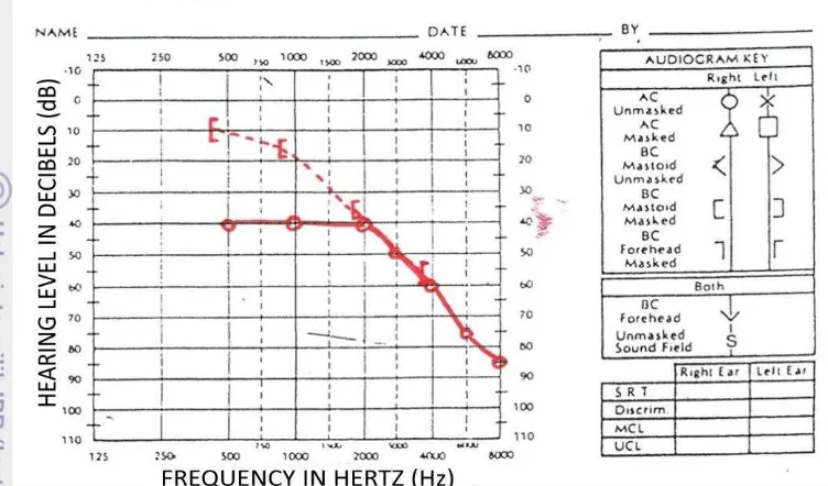 Gambar 9  Grafik audiogram subjek tuli sangat berat 