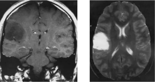 Gambar 4. MRI low grade astrositoma, A. Axial CT scan, precontrast and postcontrast. B