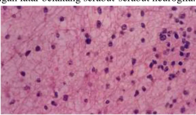 Gambar 5. Astrositoma Fibiler Low-grade   DIAGNOSIS BANDING