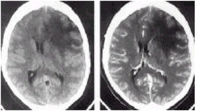 Gambar 1. CT scan low grade astrocytoma, kiri tanpa kontras, kanan dengan kontras, tidak