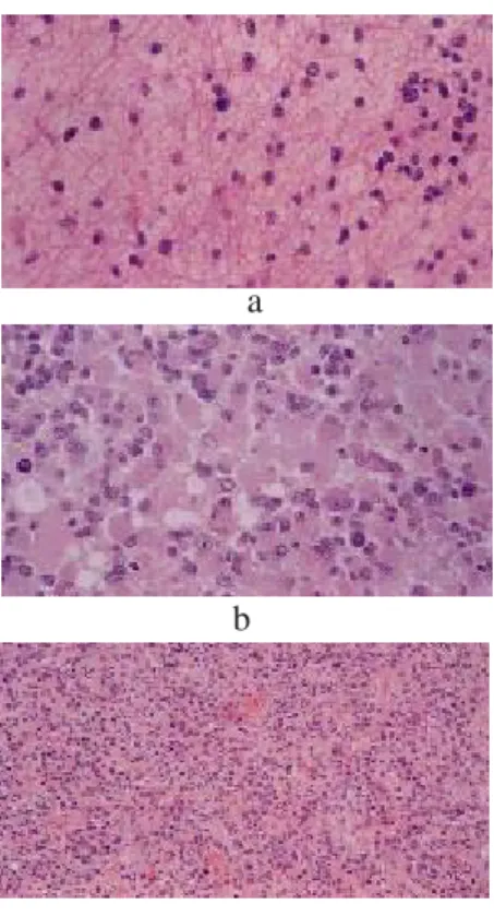 Gambar 3. Gambaran histopatologi (a) astrocytoma fibrillary, (b) astrocytoma gemistocytic, (c) astrocytoma anaplastic
