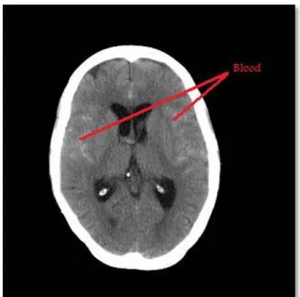 Gambar 4. CT scan Perdarahan Subarakhnoid 