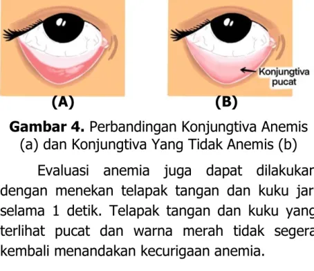 Gambar 4. Perbandingan Konjungtiva Anemis  (a) dan Konjungtiva Yang Tidak Anemis (b) 