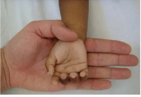 Gambar 5. Perbandingan warna pucat tangan  pasien anemia usia 2 tahun (Hb 3.6g/dL) dan 