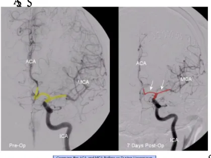 Gambar 1. Angiografi  cerebral, injeksi arteri karostis interna kiri ( Kiri ) pre –  op; ( Kanan ) 7 hari setelah post op