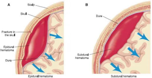 Gambar 2. Epidural hematom dan subdural hematom  13
