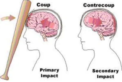 Gambar 3. Coup and countercoup lesion 14