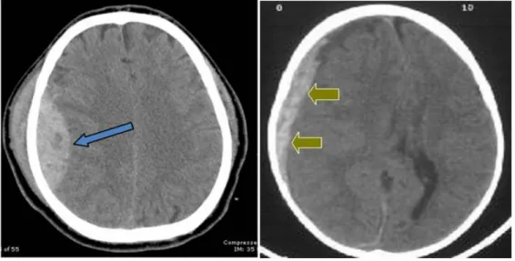 Gambar 4.Epidural hematom  7 Gambar 5.Subdural hematom 6