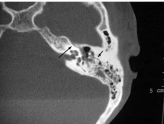 Gambar 4.  Aksial noncontrast CT scan pada patah tulang longitudinal tulang temporal (panah)