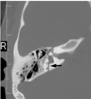 Gambar 5. Aksial noncontrast CT scan patah tulang transversal pada tulang temporal (panah)