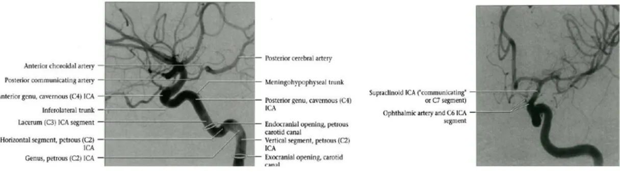 Gambar  2.  DSA  lateral  a.  karotis  interna  kanan  menunjukkan  segmen  a.  karotis  interna