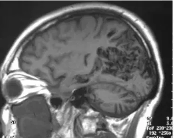 Gambar  12.    MRI  T1WI  kepala  sagital  memperlihatkan  AVM  yang  luas  di  oksipital