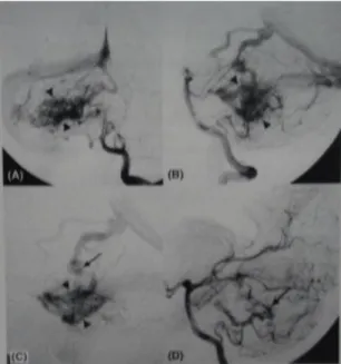 Gambar  14.    Plexiform  AVM  (Kepala  panah,  A  B  dan  C).  (A)  AP  angiogram.  (B)  Lateral  angiogram