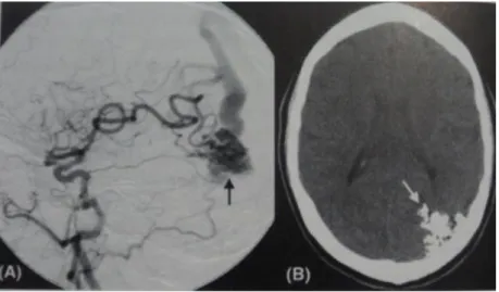 Gambar 16.  Sucal AVM. (A) Triangular nidus (panah) pada lateral angiogram. (B)  NBCA pada nidus (panah) pada CT kepala non kontras